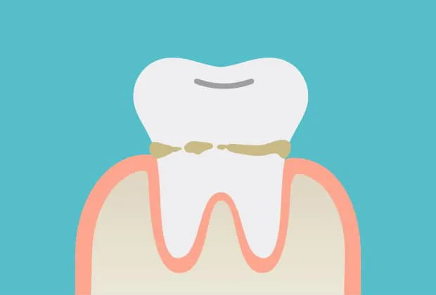 磨き残しが特に多い、歯と歯茎のすき間にプラーク(歯垢)ができる