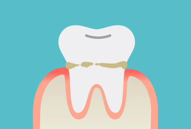 プラークに含まれる細菌によって歯茎に炎症が生じる（軽度歯周病＝歯肉炎）
