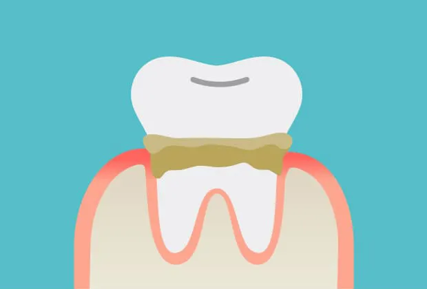 プラークが歯石へと変化する。歯石が歯の表面や歯周ポケットと呼ばれる歯茎の内部で形成される