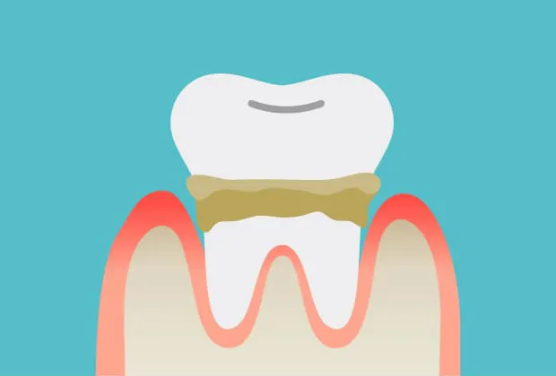 歯石になると歯磨きでは除去できないため、歯石の内側にプラークが増殖する