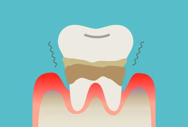 プラークが放出する毒素が骨を溶かし、歯がグラグラし始める（中度度歯周病）