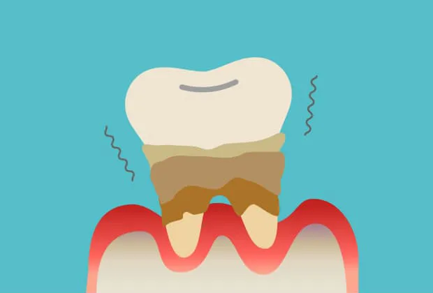 歯を支えている骨が溶けてなくなることで、歯周ポケットが深くなり、歯茎が下がる