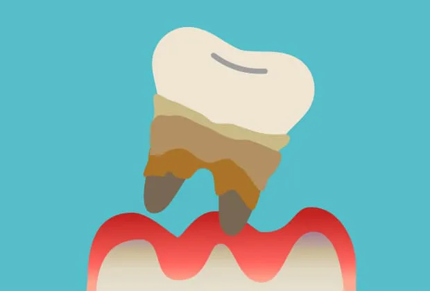 膿や口臭などの症状が見られるようになり、やがて歯が抜け落ちる（重度歯周病）